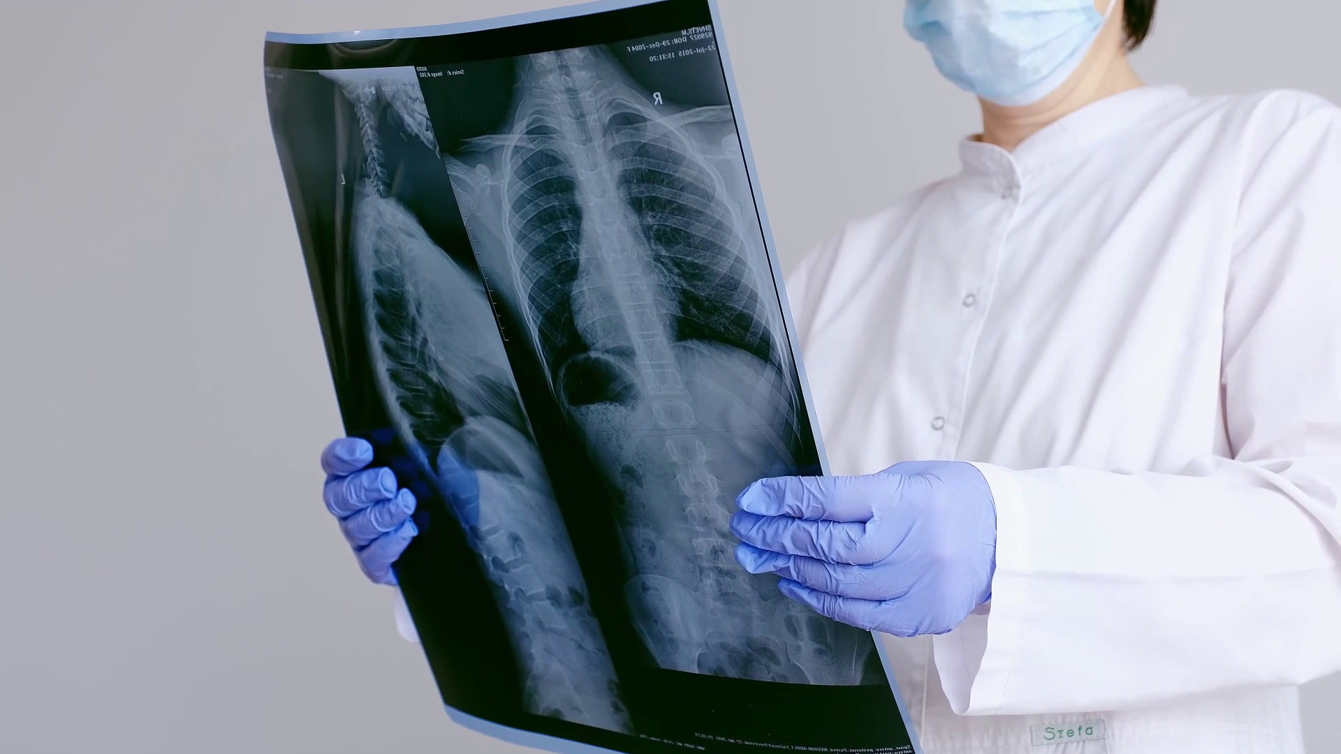 Tumori rari, i sarcomi richiedono diagnosi tempestive e alta specializzazione