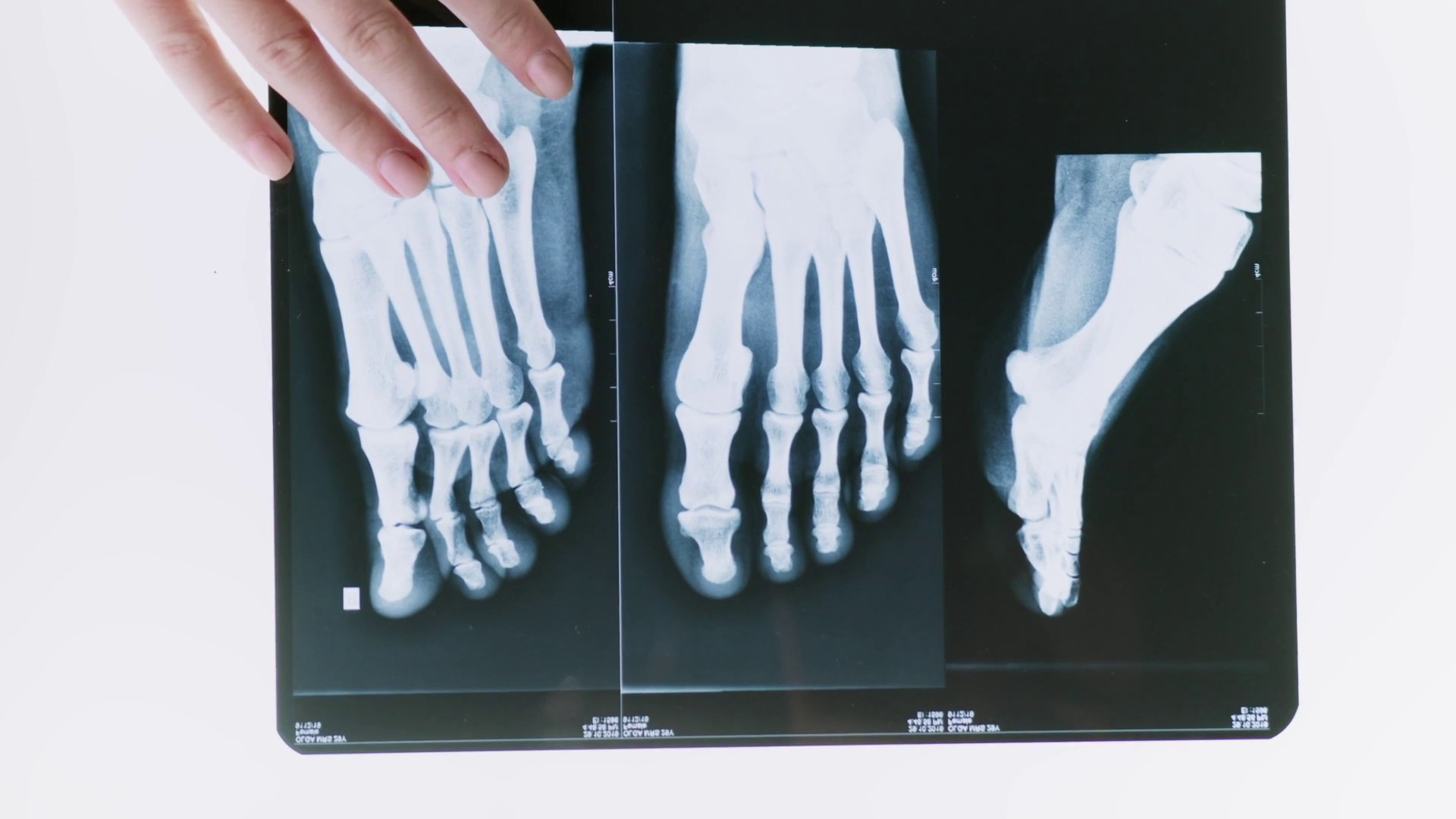 Ortopedia, le fratture non sono tutte uguali